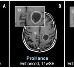 Two brain metastases from primary lung cancer are contrast enhanced in the brain of a 61-year-old male. Speakers at AHRA 2019 will state that ProHance and other macrocyclic MR agents present a very low risk to patients. Images courtesy of Bracco