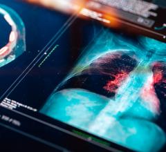 A look inside the imaging industry’s efforts to enhance lung cancer screenings