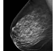 CAD's ProFound AI Improves Efficiency and Accuracy in Breast Cancer Detection