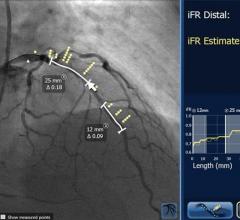 SyncVision iFR Co-registration from Philips Healthcare maps iFR pressure readings onto angiogram.