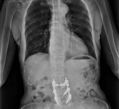 Advances in long-length digital radiography are creating opportunities for visualization during spinal surgery, as well as pre- and post-operatively. Image courtesy of Fujifilm Medical Systems