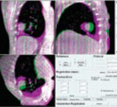 symmetry baseline shift, elekta treatment plan, VMAT, tomotherapy