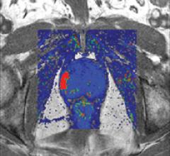 VividLook software helps spot cancer by imaging the speed of contrast flow into 