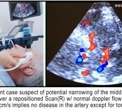 Adult patient case suspect of potential narrowing of the middle cerebral artery, however, a repositioned scan (right) with normal Doppler flow approximating 60 cm/s implies no disease in the artery except for tortuosity.