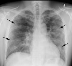 COVID-19 progression over 4 days in a 28-year-old man. This posteroranterior chest X-ray \ shows bilateral multiple peripheral and lower lobe ground glass opacities (GGOs) shown by the arrows. Image courtesy of Margarita Revzin et al. 
