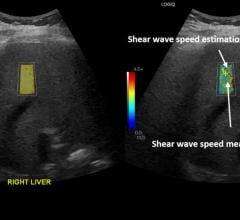 Figure 1. A 55-year-old female with a history of COVID-19 infection 38 weeks before the date of ultrasound shear wave elastography. The shear wave speed of 1.91 m/s corresponds to Young’s modulus of 10.94 kPa which indicates abnormally high liver stiffness and may reflect chronic liver injury.