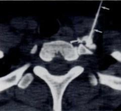  CT-guided stellate ganglion injection. (Courtesy of Radiology)