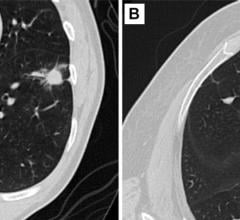 Figure 2. Axial CT images of pulmonary nodules. (A) Malignant nodule. (B) Benign nodule.
