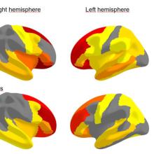 Figure 2. The cortical thickness of prefrontal regions is negatively associated with weight and BMI measurements, meaning that higher weight and BMI are related to lower cortical thickness.