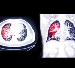 Research finds that a commonly used risk-prediction model for lung cancer does not accurately identify high-risk Black patients who could benefit from early screening