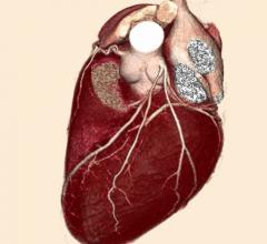 radiation therapy, breast cancer, breath hold, heart, clinical study