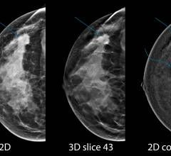 Machine Learning Identifies Breast Lesions Likely to Become Cancer