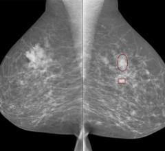 iCAD Introduces ProFound AI for 2D Mammography in Europe