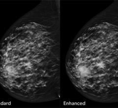 concurrent-read cancer detection solution for digital breast tomosynthesis 