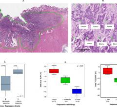 Methodology for evaluation of tumor cell density (TCD) and allocation of radiotherapy response categories. (A) Virtual graticule of approximately 300 points applied to tumor area on a digital H&E section. (B) Demonstration of TCD point scoring. (C) Box and whisker plot to show the relationship between ΔTCD and American Joint Committee on Cancer (AJCC) Tumour Regression Grade System (TRG). (D, E) Allocation of three radiotherapy response groups according to change in TCD (ΔTCD) for short-course radiotherapy 