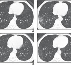 #COVID19 #Coronavirus #2019nCoV #Wuhanvirus #SARScov2 Updated CT scoring criteria from AJR considers both lobe involvement and changes in CT findings to quantitatively and accurately evaluate the progression of COVID-19 pneumonia
