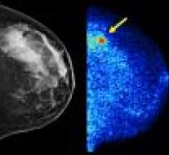 Molecular Imaging to Improve Cancer Detection in Dense Breasts