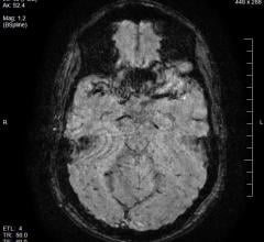 fMRI, brain circuits, stress response, Yale study, PNAS
