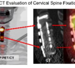 SNM 2011 Image of the Year: 18F NaF PET/CT Evaluation of Cervical Spine Fixation Hardware