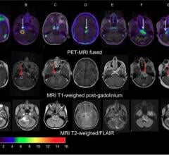 PET/CT Helps Predict Therapy Effectiveness in Pediatric Brain Tumors