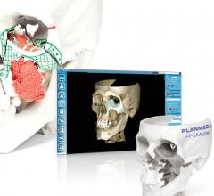 Planmeca ProModel, 3-D printing, first Nordic facial tissue transplant procedure