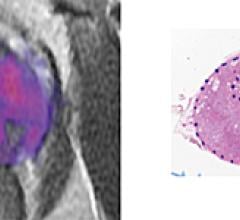 prostate cancer, MRI, RSI, restriction spectrum imaging, tumor grade, UC San Diego study