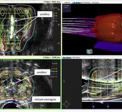 prostate cancer, radiation therapy, high-dose-rate brachytherapy, HDR, Red Journal study