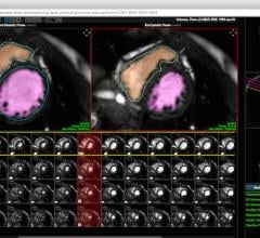 Heart Imaging Technologies, Precession, cardiac magnetic resonance, software