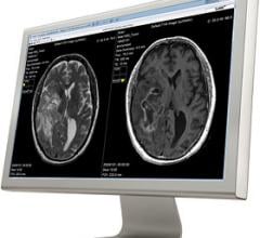 SyntheticMR Myelination Quantification Feature Receives CE Mark
