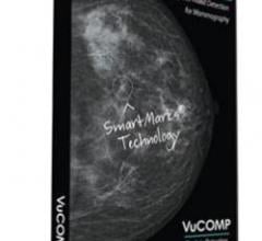 mammography systems rsna computer aided detection women's health vucomp konica