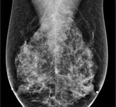 VuComp, M-Vu CAD, mammography, version 3.2