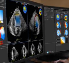 EchoInsight for Cardio Oncology Clinical Study Left Ventricle Function