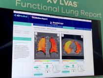 The XV LVAS digital Ventilation Report, exhibited by 4D Medical during RSNA 2022, includes data that radiologists can use to provide actionable insights to their referring clinicians. Data includes Ventilation Defect Percentage (VDP), Tidal Volume, and Ventilation Heterogeneity. The color-coded lung images show areas of high ventilation (red), normal ventilation (green), and over-ventilation (blue), based on LVAS mathematical analytics.