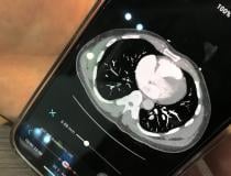 Aidoc's artificial intelligence pulmonary embolism response team (PERT) activation app showing how the CT scan can be viewed on a smartphone. The orange dots at the bottom of the page mark key slices were the AI detected pulmonary emboli.