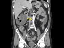 Aortic thrombosis from COVID at the level of the inferior superior mesenteric artery. The patient also had superior mesenteric artery thrombosis complicated by bowel ischemia and perforation in this 54-year-old man who presented to the emergency department with abdominal pain and was diagnosed with COVID-19. 
