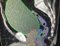 This is an example of artificial intelligence being used to automatically identify and contour anatomical structures for radiation therapy with the Mirada DLCExpert software. This example shows OAR Space hydrogel (outlined in blue) injected to create space between the prostate and the rectum to prevent damage to that radiation sensitive structure. The gel is hard to identify on the CT scan because it looks like part of the rectum or prostate. But the software has been trained to identify it when present.