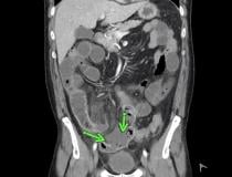 Superior mesenteric artery thrombosis complicated by bowel ischemia and perforation in a 54-year-old man who presented to the emergency department with abdominal pain and was diagnosed with COVID-19. Contrast-enhanced CT images of the abdomen and pelvis show mucosal hyperenhancement involving the small bowel (green arrows). 