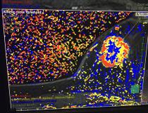 Five new advanced visualization apps were released this week at HIMSS 2019 for Fujifilm’s Synapse 3D radiology software. These are images from a new magnetic resonance imaging (MRI) breast analysis software. The colorful kinetic curve threshold view shows the wash in and wash out of gadolinium contrast to define if a tumor is benign or a cancer.