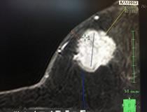Five new advanced visualization apps were released this week at HIMSS 2019 for Fujifilm’s Synapse 3D radiology software. These are images from a new magnetic resonance imaging (MRI) breast analysis software. The colorful kinetic curve threshold view shows the wash in and wash out of gadolinium contrast to define if a tumor is benign or a cancer.