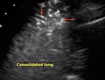 An example of COVID-19 (SARS-CoV-2) pneumonia lung consolidation on ultrasound. See this image moving in the <a href="https://www.itnonline.com/videos/video-covid-pneumonia-lung-consolidation-ultrasound" target="_blank">VIDEO: COVID Pneumonia Lung Consolidation on Ultrasound</a>.