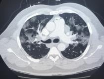 An American COVID-19 positive patient computed tomography (CT) lung scan showing ground glass lesions caused bu coronavirus pneumonia. Image from radiologist John Kim. Rea the related article a href=https://www.itnonline.com/content/ct-provides-best-diagnosis-novel-coronavirus-covid-19">CT Provides Best Diagnosis for Novel Coronavirus (COVID-19).</a>