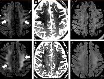 Figure 1 from the Radiology article. Brain MRI in two critically ill COVID-19 patients with persistently depressed mental status including a 56-year old man (A-C), and a 64-year old man (D-F). Axial diffusion-weighted (A, D), apparent diffusion coefficient (B, E) and FLAIR (C, F) images at the level of centrum semiovale in both patients demonstrate symmetric diffuse T2/FLAIR hyperintensity (arrowheads) and mild restricted diffusion (thick arrows) involving the deep and subcortical white matter with relative