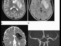 From a Radiology article: Axial T2-weighted (a) and FLAIR (b) Magnetic resonance imaging show diffuse hyperintense signal and edema of the caudate nucleus head, putamen, anterior limb of the internal capsule, and parts of external capsule and insula on the left side, with corresponding low values on the axial apparent diffusion coefficient map, in keeping with an acute infarct. Time-of-flight magnetic resonance angiography maximal intensity projection reformatted image demonstrates focal irregular narrowing