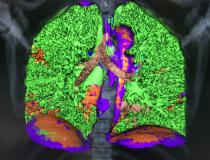 This is a COVID-19 patient's lungs on Canon’s new advanced visualization lung analysis tool. It uses both tissue density measured with the CT Hounsfield units and tissue texture to mark and quantify areas of COVID pneumonia consolidations. It was cleared under an FDA emergency use authorization and showed at the the 2021 HIMSS meeting. The green shows areas of normal lung, and areas of red are COVID. The software can auto quantify these areas to use as a baseline to assess long-haulers.