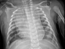 Chest X-ray of a pediatric patient with heart failure from COVID. Chest X-ray of a  2-month-old infant diagnosed with COVID-19 showing an enlarged heart, bibasilar opacities caused by collapse of the lower sections of lungs, and right upper lobe atelectasis (lung collapse). 