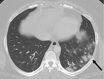 A 26-year-old man with history of diabetes and hypertension presented with 7 days of fever, chills, nausea, intractable vomiting, diarrhea and generalized weakness, but no specific upper or lower respiratory symptoms aside from mild shortness of breath. The patient was diaphoretic and retching on arrival. Physical examination showed diffuse abdominal tenderness, mild tachypnea and tachycardia.
