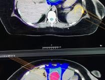 This is a comparison of a machine learning and human created treatment plans for pancreatic cancer radiation therapy displayed by Raysearch on the expo floor at the ASTRO 2019 meeting today.  The vendor received FDA approval for this machine learning technology and auto segmentation for both MRI and CT.#ASTRO19 #ASTRO2019 #ASTRO