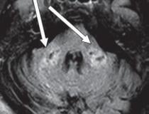 COVID-19-related disseminated leukoencephalopathy (CRDL) represents an important, although uncommon, differential consideration in patients with neurologic manifestations of coronavirus. Axial FLAIR MR image shows T2 prolongation in bilateral middle cerebellar peduncles (arrows). Findings were associated with restricted diffusion and areas of T1 hypointense signal without enhancement or abnormal susceptibility. Image courtesy of American Roentgen Ray Society (ARRS), American Journal of Roentgenology (AJR).