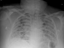Chest X-ray from patient severely ill from COVID-19, showing (in white patches) infected tissue spread across the lungs. Image courtesy of Nature Publishing or npj Digital Medicine