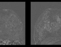 Left image shows breast MRI in 41-year-old patient without IUD. Right image shows increased parenchymal enhancement in the same patient 27 months after IUD placement. Image courtesy of RSNA